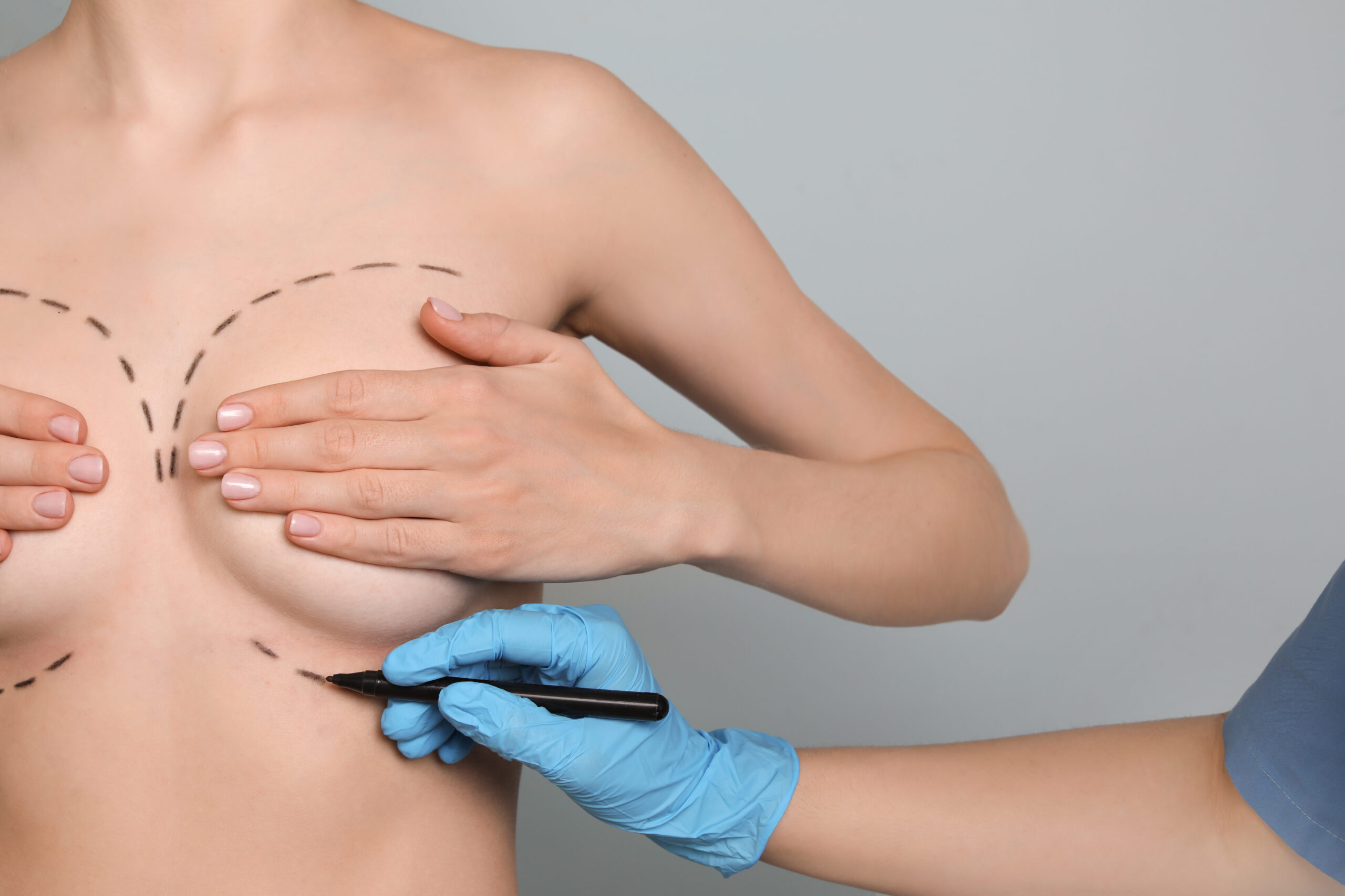 Breast augmentation (mammaplasty) concept image representing implant-based enhancement