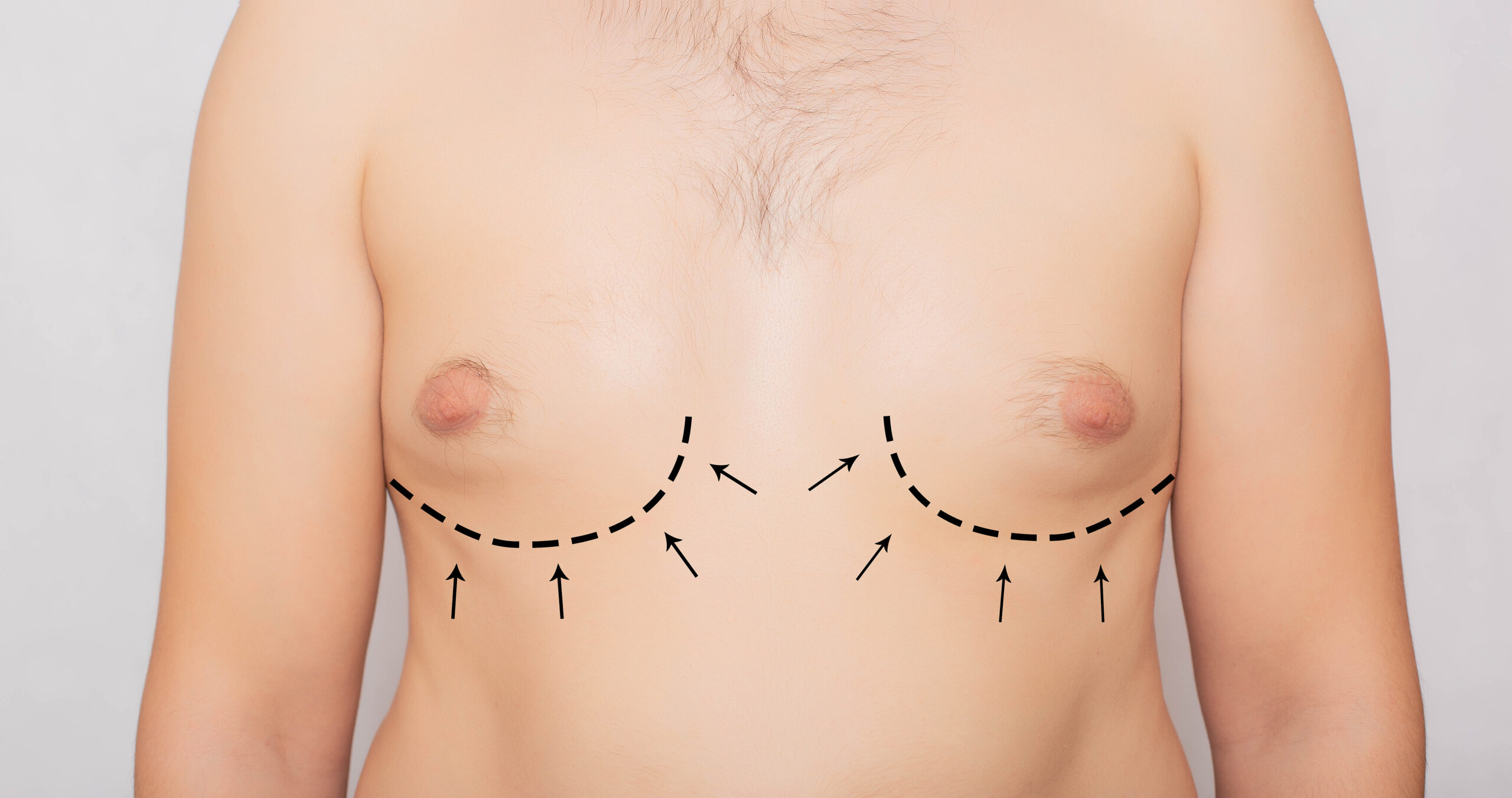 Male breast reduction (gynecomastia) concept image for chest contour refinement