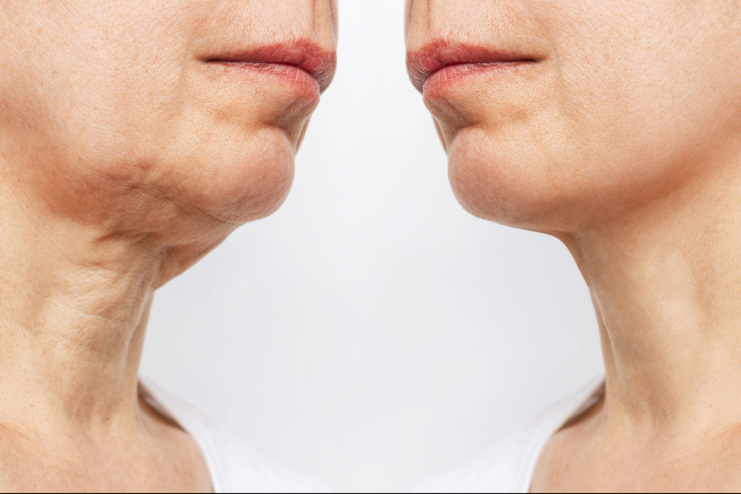Defined jawline and refined neck contour after neck lift
