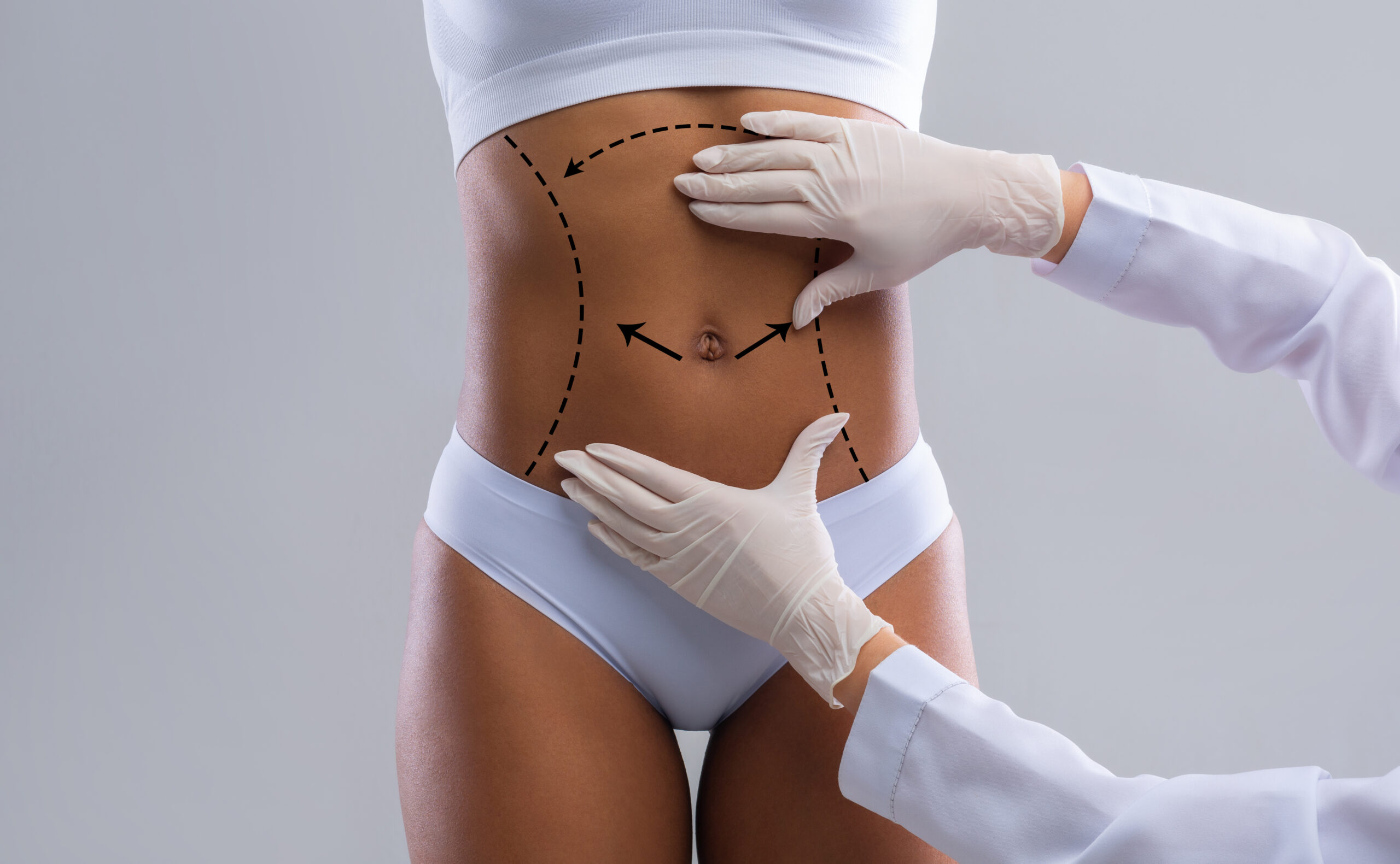 Tummy tuck (abdominoplasty) concept image for abdominal contouring and muscle repair